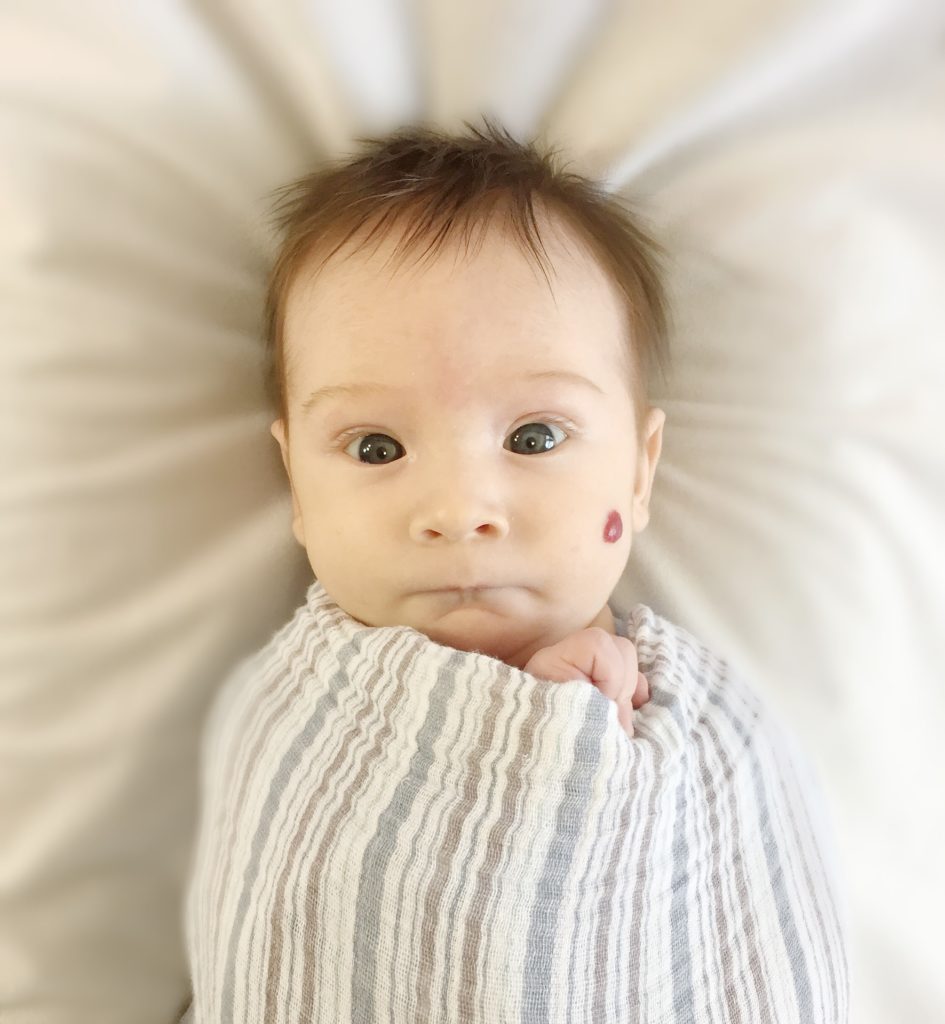 Strawberry Hemangioma on a  cute baby's left cheek