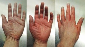 Mottled Skin