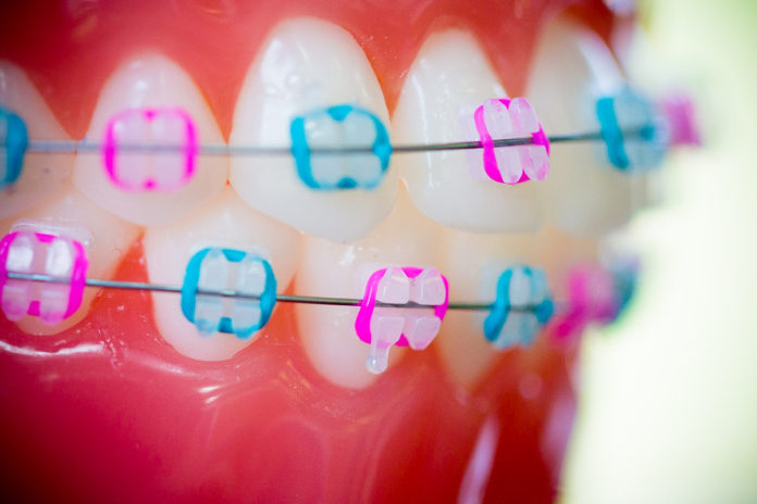 Braces colors