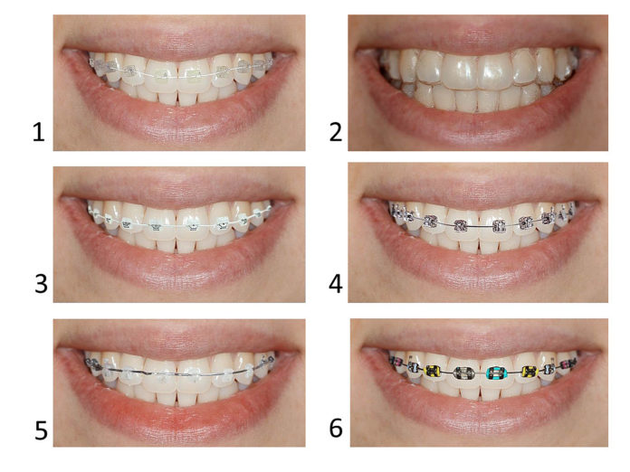 Types Of Braces