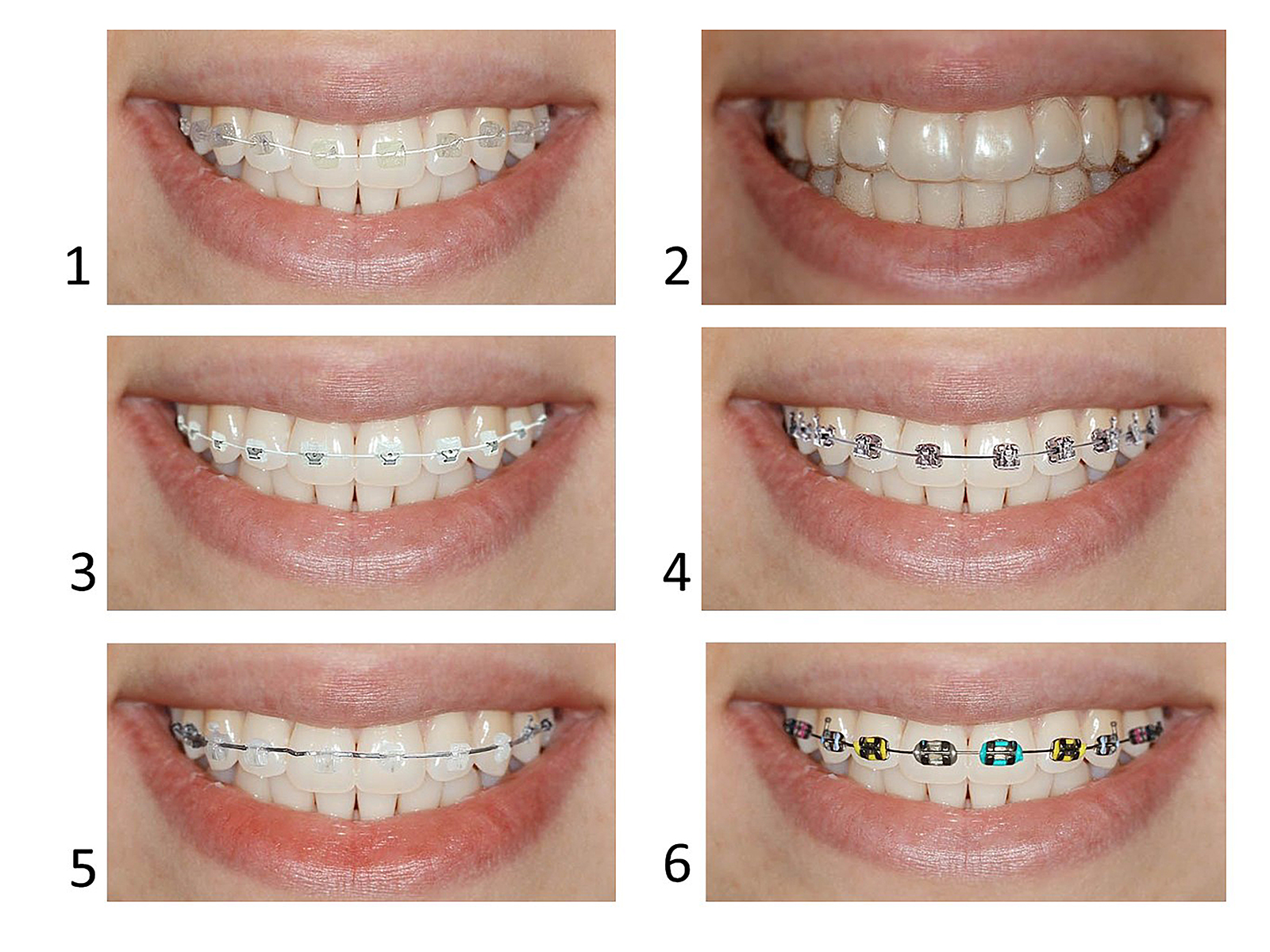 Types Of Braces.