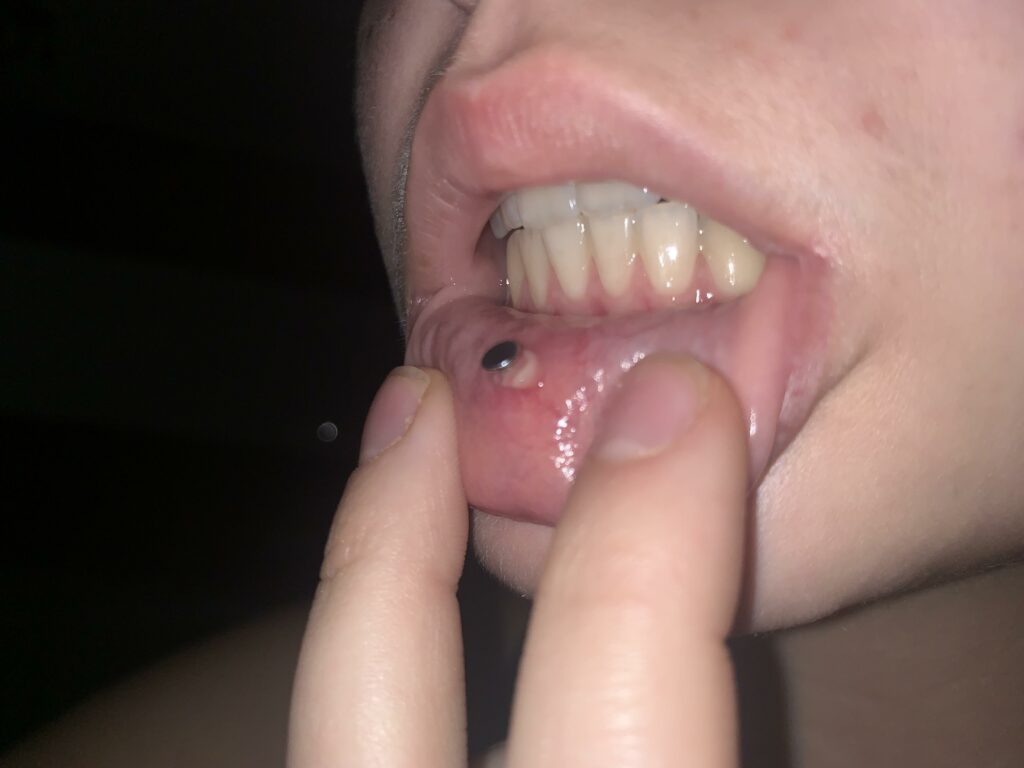 Infected lip piercing 